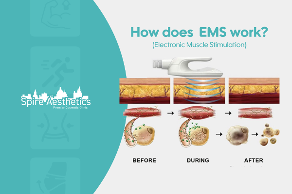 EMS treatment for post pregnancy weight loss treatment Stevenage Ware