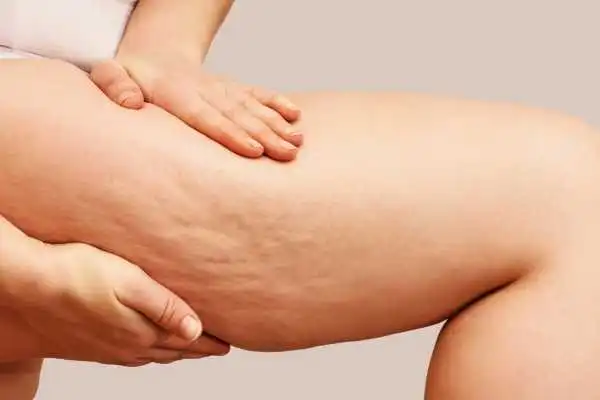 Image of woman showing leg with cellulite Stevenage Ware