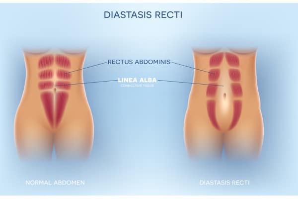 What Non-Surgical Options Are Available for Diastasis Recti Stevenage Ware?