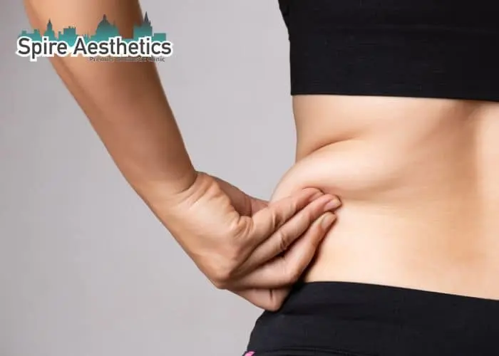Image of woman pinching fat on their hips Stevenage Ware. Fat Freezing treatment