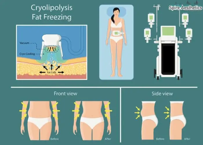 Fat freezing treatment Stevenage Ware benefits for competitions to remove stubborn fat deposits.