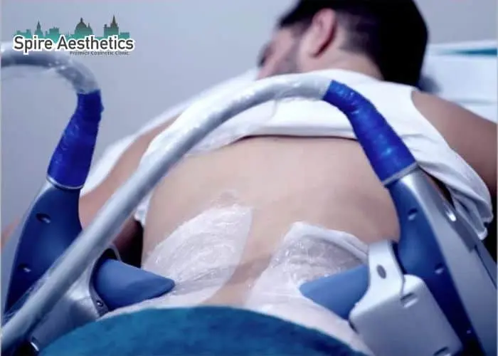 Man having fat freezing treatment done on love handles before a competitions Stevenage Ware to create a sculpted look.