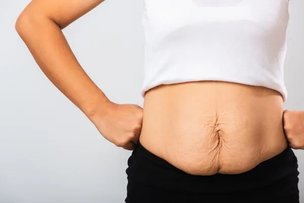 Image of a woman's stomach after weight loss with sagging skin following a gastric band Stevenage Ware
