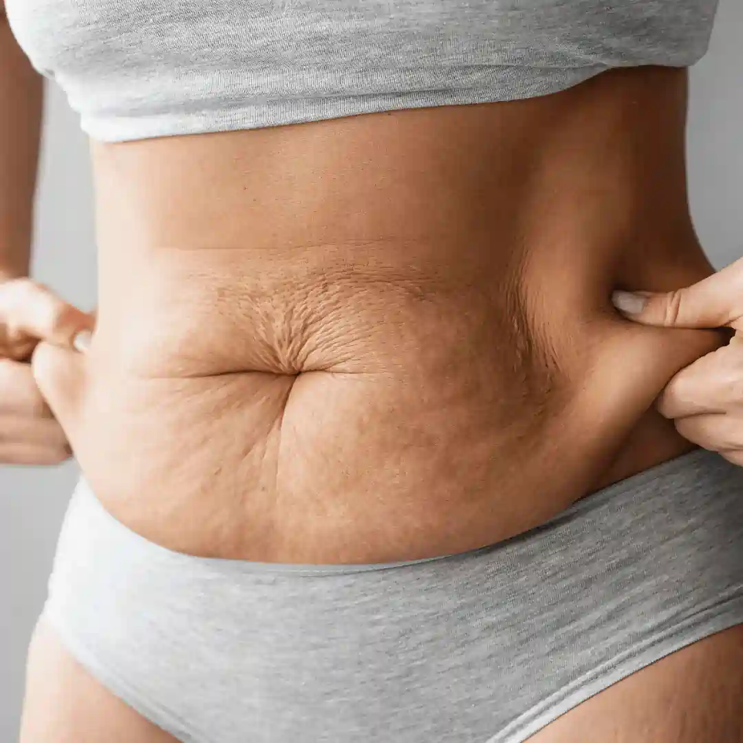 Is It Normal to Have Loose Skin After Pregnancy Stevenage Ware?